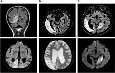 Can Intestinal Pseudo-Obstruction Drive Recurrent Stroke-Like Episodes in Late-Onset MELAS Syndrome? A Case Report and Review of the Literature